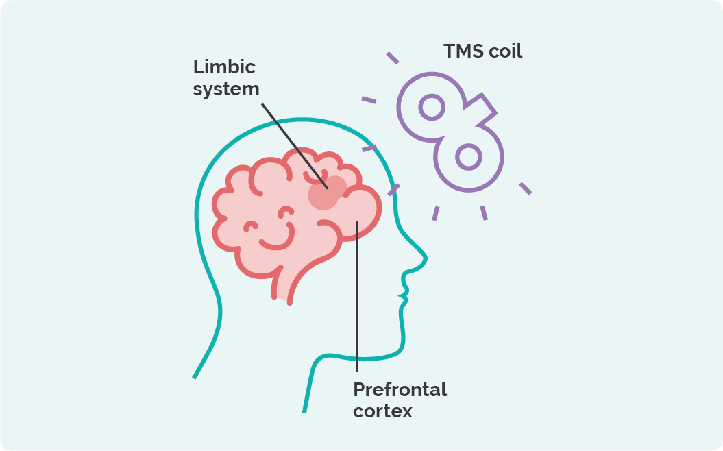 Repetitive TMS | rTMS | Repetitive Transcranial Magnetic Stimulation rTMS | How Does rTMS Work? Monarch Mental Health Clinic Australia Repetitive TMS | rTMS | Repetitive Transcranial Magnetic Stimulation rTMS | How Does rTMS Work? Monarch Mental Health Clinic Australia